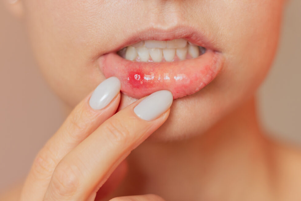 Frequent Mouth Sores: Identify Triggers and Know When to Seek Advice